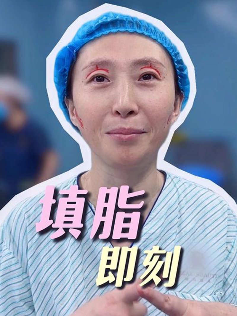 脂肪填充